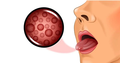 Inflamația papilelor gustative