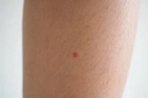 Petele roșii pe picioare: de ce apar și cum se tratează?