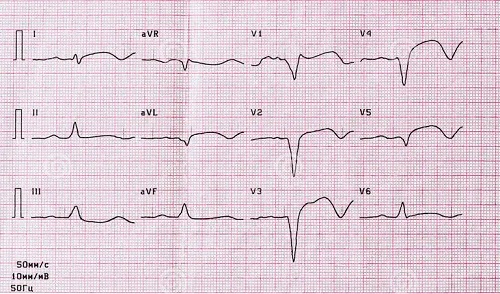 Rezultatul unui EKG