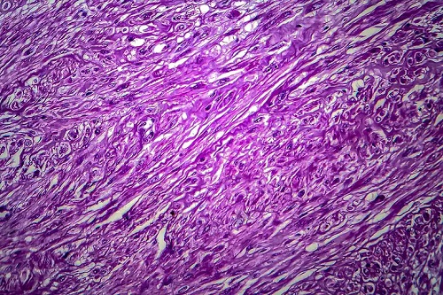 Date despre fibromul uterin oferite de microscop
