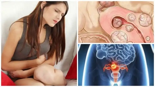 Cele mai importante date date despre fibromul uterin