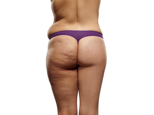 Femeie care are nevoie de dietă pentru a elimina celulita