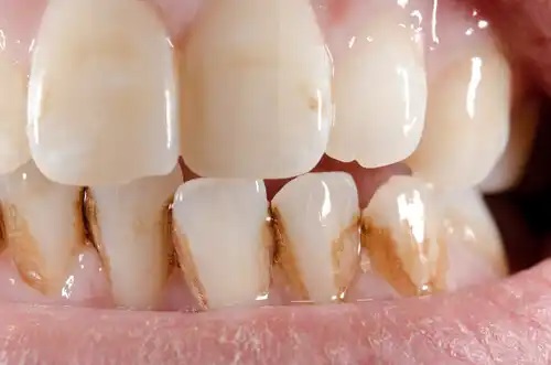 Cum se elimină tartrul de pe dinți în mod natural