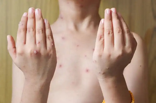 Persoană cu herpes zoster