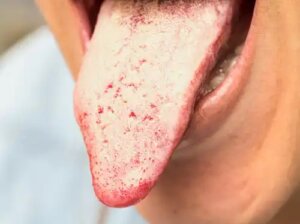 5 remedii naturiste pentru a trata candidoza