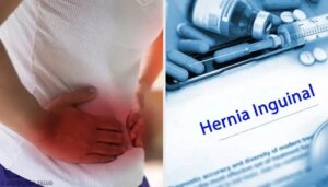 Remediu natural pentru hernii