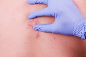 Tratamente naturale pentru zona zoster sau herpes zoster