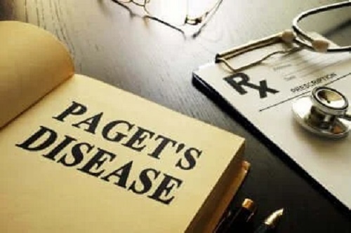 Simptomele și tratamentul bolii Paget: tot ce trebuie să știi