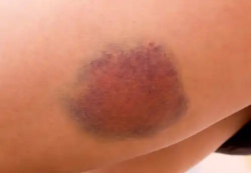 Vânătăile pot fi simptome ale cancerului pe care mulți le ignoră