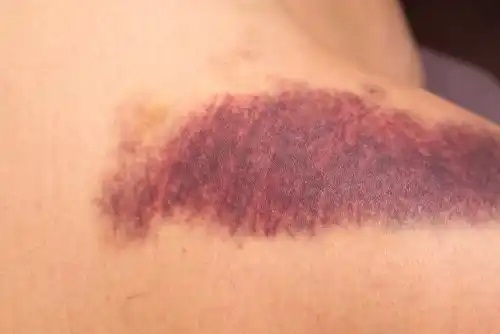 Vânătăile sunt simptome ale lipsei de vitamina K