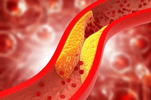 Dieta ketogenică crește nivelul de colesterol?