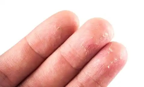 Eczemă care produce mâncărime la degete