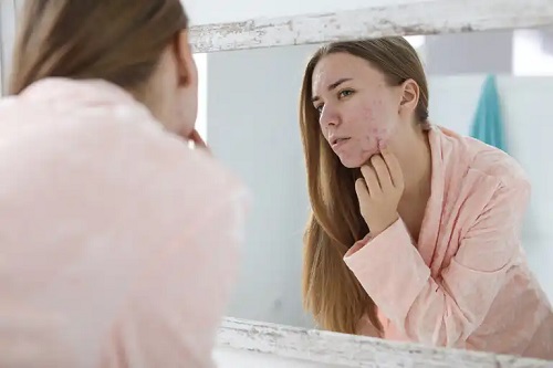 Fată care are nevoie de Roaccutane