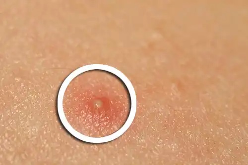 Furuncul inflamat