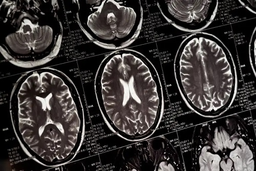 Imagini cu creier la RMN