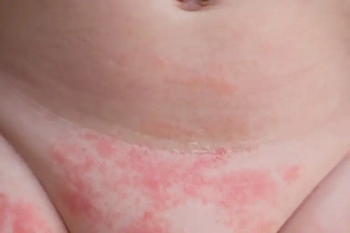 Îngrijirea pielii bebelușului cu dermatită