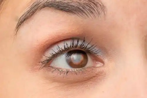 Ochi cu simptome ale cataractei