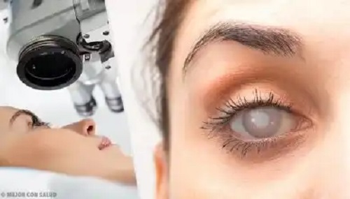 9 simptome ale cataractei și tratamente naturale