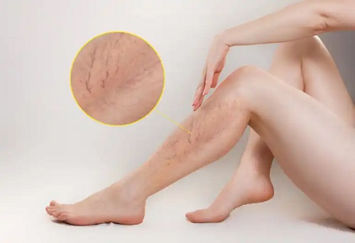 Cele mai bune 10 soluții pentru tratarea varicelor