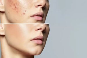 Roaccutane: ce este, pentru ce este și care sunt efectele secundare?