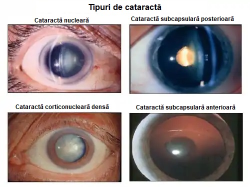 Tipuri de caractă