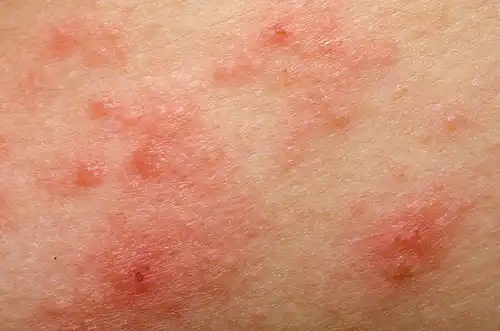 Este indicat să folosiți tratamente naturiste pentru rozacee?