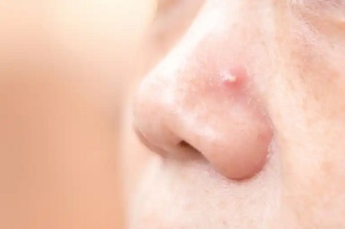 Cum să tratezi coșurile de pe nas cu 4 remedii naturale