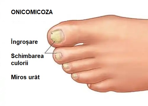 Ciuperca unghiei