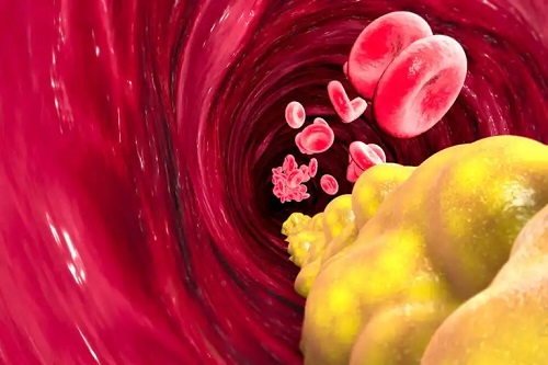 Colesterol în vase de sânge