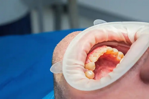Efecte secundare ale excesului de oțet de mere la nivel bucal