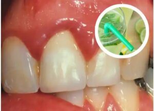 5 soluții naturale pentru sângerarea gingiilor