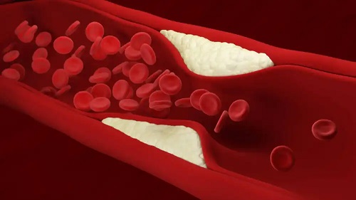 Arteră plină de colesterol
