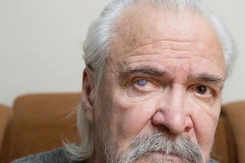 Bărbat cu cataractă