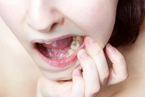 Cariile provoacă probleme dentare la adolescenți