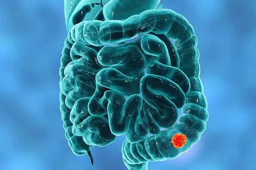 Chirurgia J-Pouch în cancerul de colon