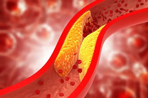 Colesterol pe artere