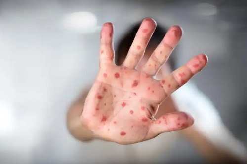 Noul focar de variola maimuței: ce știm despre acest virus?