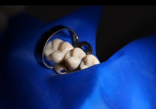 Lucrare dentară cu cleme