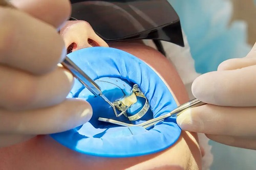 Medic care folosește capsele sau clemele dentare