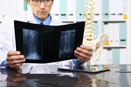 Medic care caută tratamentul osteofitelor