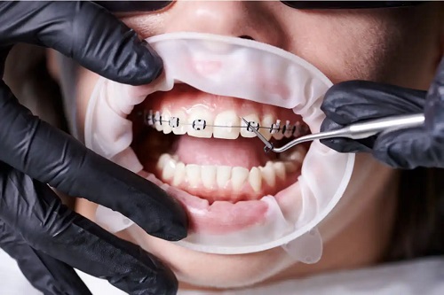 Montarea unui aparat dentar
