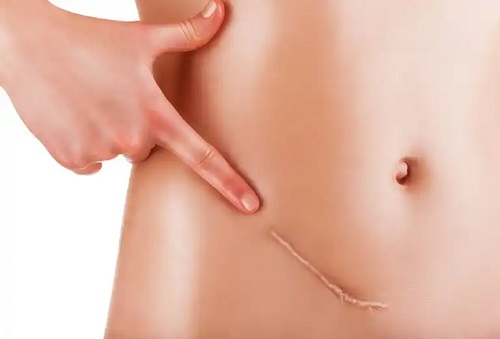 Persoană care a aflat ce este apendicectomia