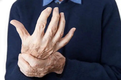 Persoană care primește terapia triplă pentru artrita reumatoidă