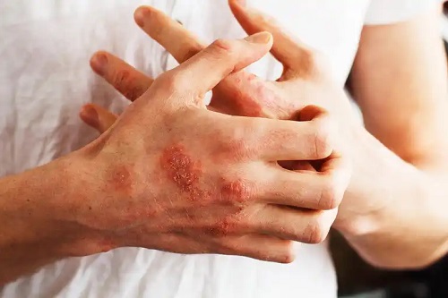 Leziuni provocate de psoriazis