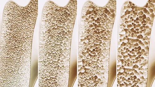 Tratamentul cu stronțiu ajută la combaterea osteoporozei