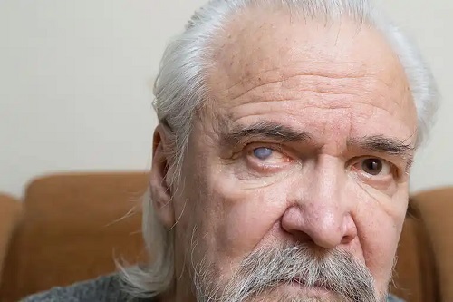 Bărbat care experimentează efecte secundare ale operației de cataractă