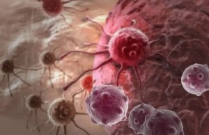 Medicamentul contra cancerului rectal a vindecat pacienții din studiu