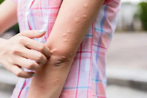 Erupția cutanată pe brațe: posibile cauze și tratamente