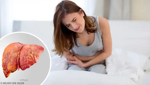 Femeie care are ciroză hepatică