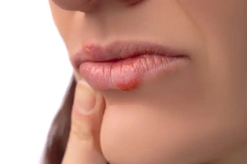Femeie care are nevoie de tratamente pentru herpesul labial